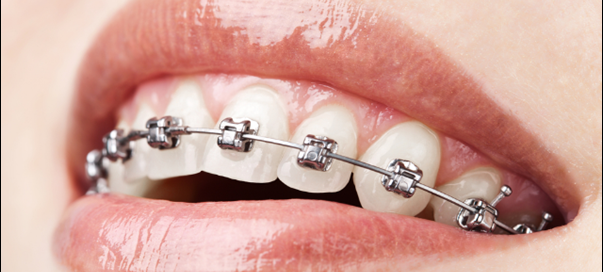 orthodontics treatment