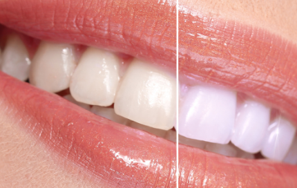 teeth whitening