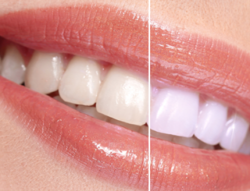Teeth Whitening: Does it Work and Is it Safe?